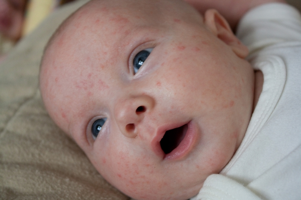 Bebeklerde Görülen Cilt Hastalığı